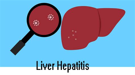 Liver Hepatitis 5 Types Causes Symptoms And When To See A Doctor 2024