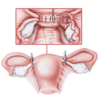 Pelvic Floor Spasms After Hysterectomy Review Home Co
