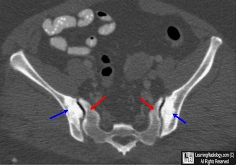 Osteitis Condensans Ilii This Is A Single Axial Image From A Ct Scan