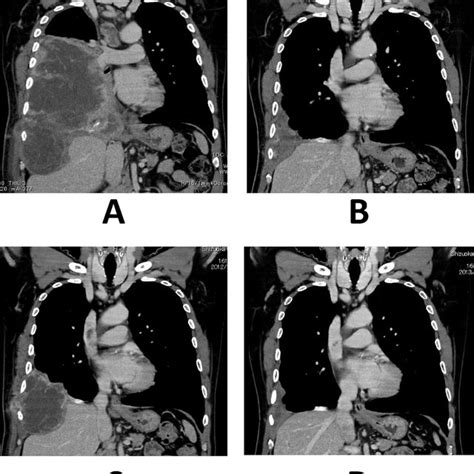 Chest Computed Tomography Scan Before Asp3026 Treatment A After