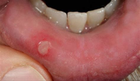 9 Treatments For Ridding Your Mouth Of Ulcers Hubpages