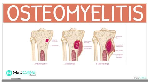 Osteomyelitis Classification Causes Pathophysiology Signs And