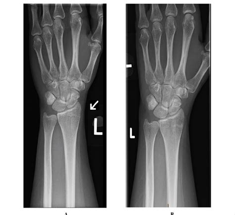 Image Of Adult Undisplaced Distal Radius Fracture Pre Splinting Image My XXX Hot Girl