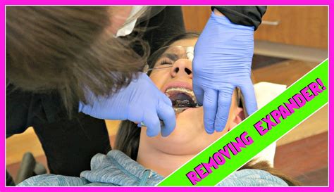 It may take more or less time, depending on your individual situation. GETTING A EXPANDER OUT ~ BRACES UPDATE | How to remove ...