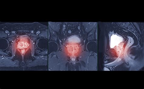 Prostate Cancer Screening With Mri After Psa A Cost Effective Strategy