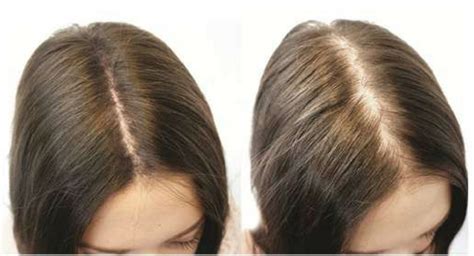 Female Pattern Baldness Causes Symptoms And Treatment — Hair Loss