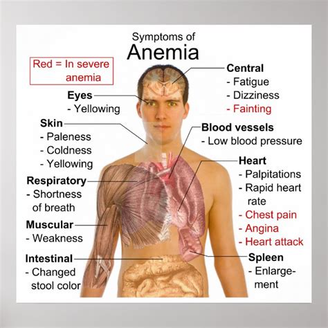 Symptoms Chart Of The Blood Disease Anaemia Nz