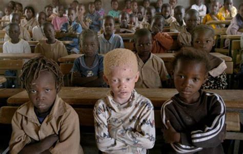 Albino People Hunted And Killed For Body Parts In Malawi