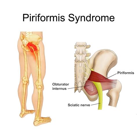 Piriformis Syndrome Running Is A Pain In The Butt Active Pt Sports