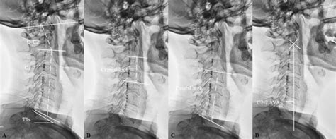 Radiographic Measurements Of Cervical Sagittal Parameters Csps In