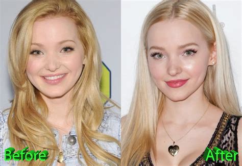 Dove Cameron Before And After Cosmetic Surgery
