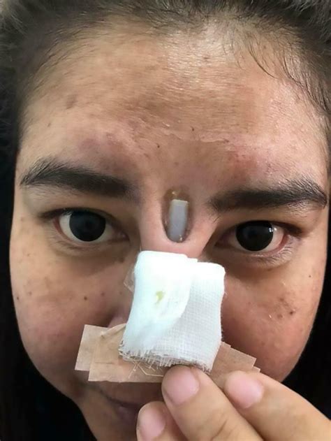 Womans Botched Nose Job Leaves Silicone Implant