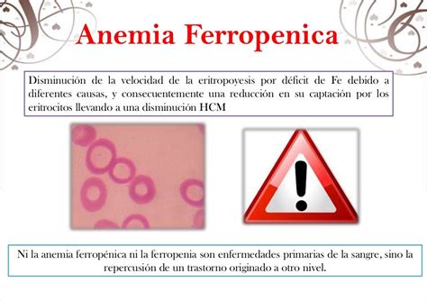 Anemia Ferropenica