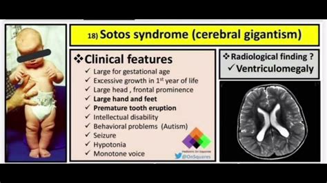 🌀 Sotos Syndrome 🌀 Youtube