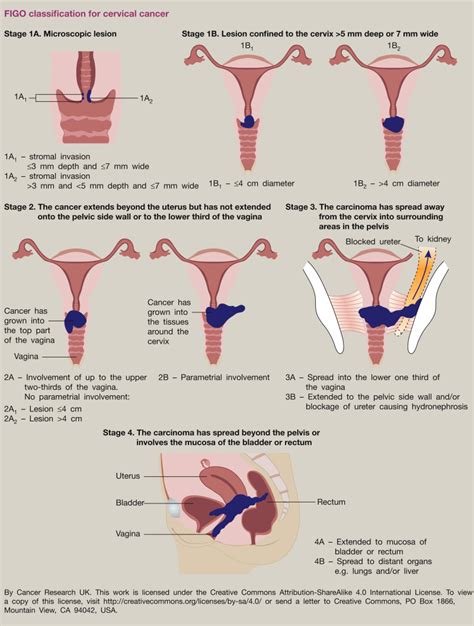 Invasive Cervical Cancer Obstetrics Gynaecology And Reproductive