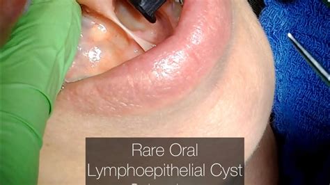Rare Oral Lymphoepithelial Cyst Floor Of Mouth Drwahan Youtube