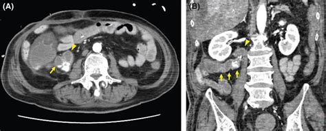 A Abdominal Contrast‐enhanced Computed Tomography Shows Extravasation