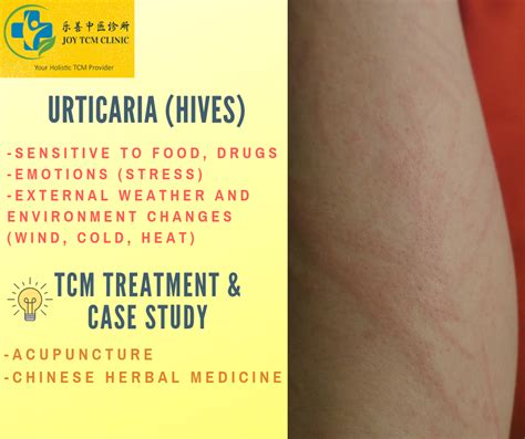 Tcm Treatment For Urticaria Or Hives