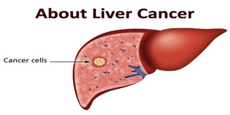 About Liver Cancer Assignment Point