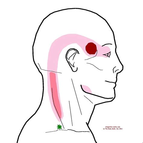 Understanding Trigger Points Headache At Your Temple Fibrochronic