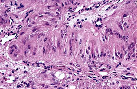 Pathology Outlines Hyalinizing Trabecular Tumor