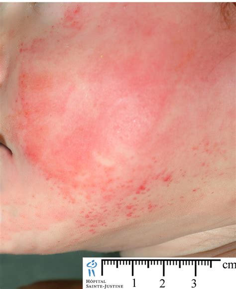 Mold Rash Pictures
