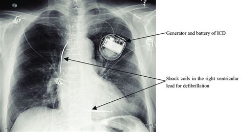 Icd Vs Pacemaker On Chest X Ray