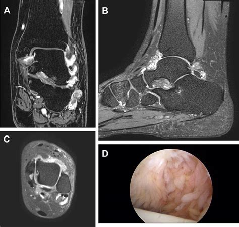 Arthroscopic Synovectomy Of The Ankle In Rheumatoid Arthritis Arthroscopy