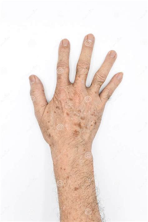 Age Spots On Hand Of Asian Elder Man They Are Brown Gray Or Black