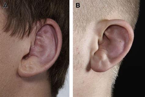 Sport Injuries Of The Ear And Temporal Bone Clinics In Sports Medicine