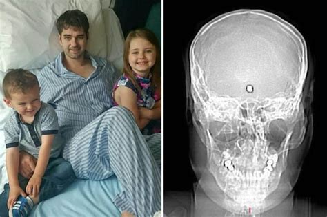 man survives being shot in the head but must live with bullet in his head daily star