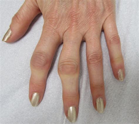 Artrosis De Mano Dolor De Dedos Y Debilidad Como Mejorarla Clínica