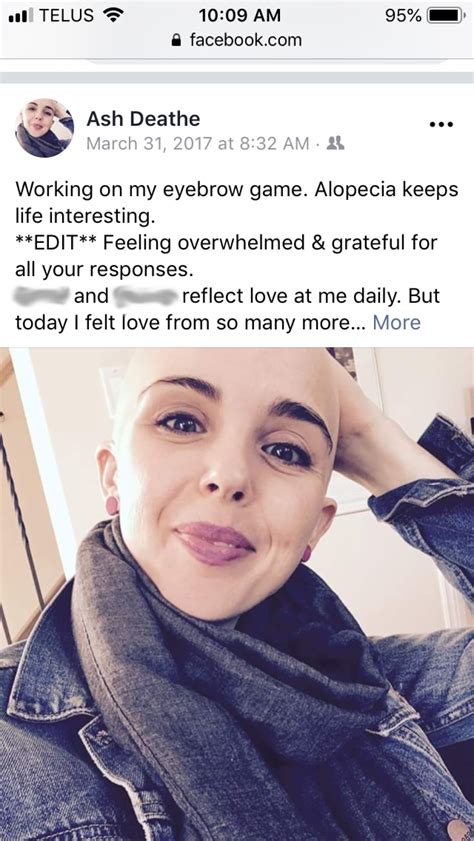 Just Bald Ottawa Woman Comes Clean About Life With Alopecia Cbc News