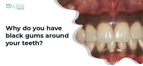 7 Causes Of Black Gums Around Your Teeth Align Dental Clinic
