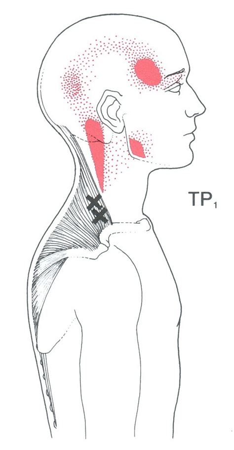Trapezius The Trigger Point And Referred Pain Guide