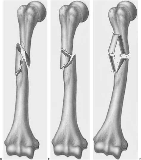 Humeral Fracture Classification