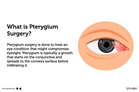 Pterygium Surgery Purpose Procedure And Benefits And Side Effects