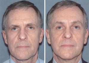 How effective is a brow lift? Endoscopic Brow Lift in Frederick, Maryland | Top Rated ...