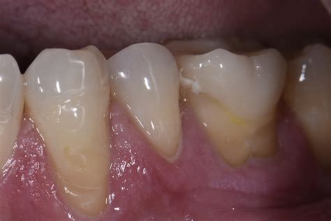 Treating Sensitive Teeth With Beautifully Skulpted Composite Resin