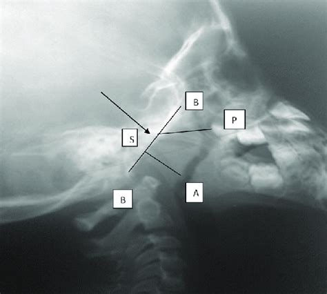 Plain Radiograph Of The Postnasal Space That Shows How Adenoidal