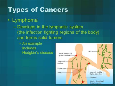Because the symptoms are nonspecific, most patients are diagnosed with the disease at an advanced stage. Most Common Lung Cancer Asbestos