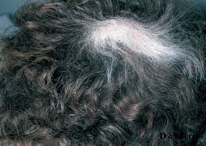 This causes only a few bare patches. 4-37 White regrowth of hair after alopecia areata