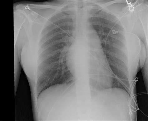 Pulmonary Valve Stenosis Chest X Ray Wikidoc