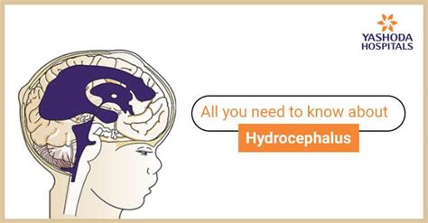Hydrocephalus Types Symptoms Causes Risk Factors Diagnosis And
