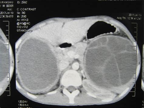 Simultaneous Primary Hydatid Cysts Of Liver And Spleen With Spontaneous
