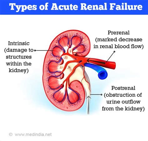 Acute Renal Kidney Failure Causes Symptoms Diagnosis Treatment