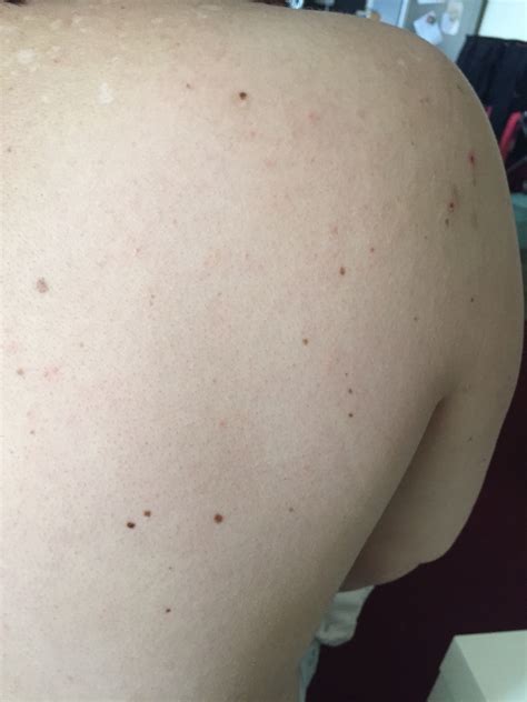 Please Help With These Skin Symptoms Itching All Over Symptom Our