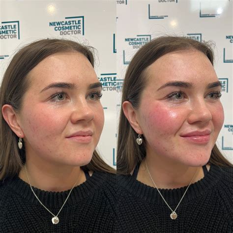 Pin by mackenzie ️‍🔥 on work | Dermal fillers, Botox, Chin