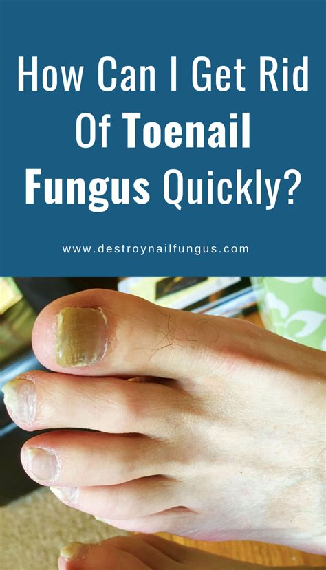 How To Get Rid Of Toenail Fungus Quickly Toenail Fungus Fungal Nail