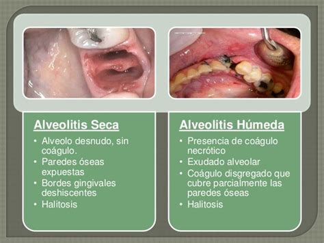 Urgencias Odontológicas Alveolitis Flegmón